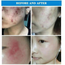Аппарат дарсонвализации Acne Meter WD-354